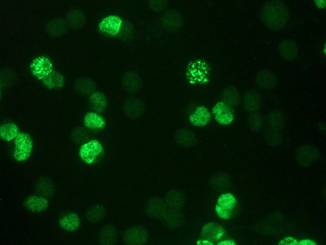 Figure 3: BrdU staining of MR65 human lung cancer cells in culture using MUB0200P (clone IIB5)